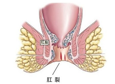 怎么判断是痔疮还是肛裂